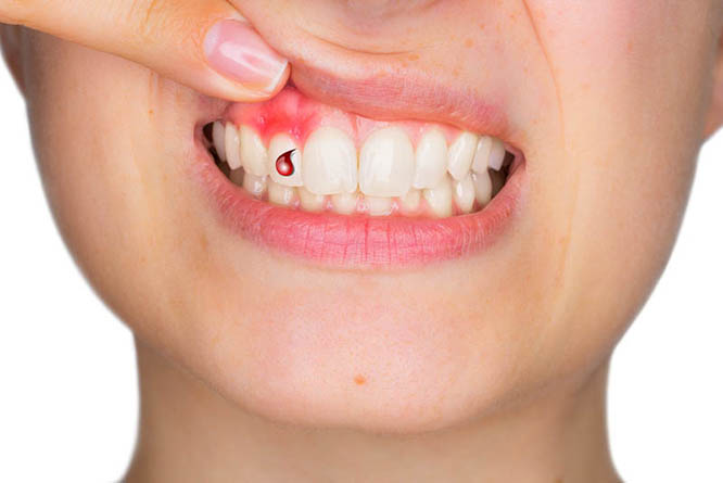 تفسير حلم خروج الدم من الاسنان في المنام لابن سيرين